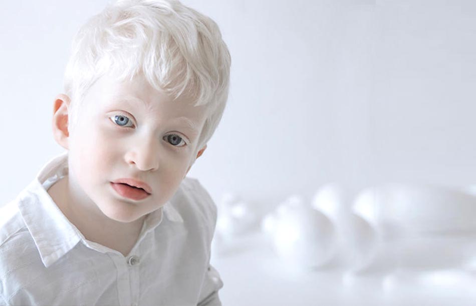 Conscientização sobre Albinismo: Muito mais do que uma questão puramente estética