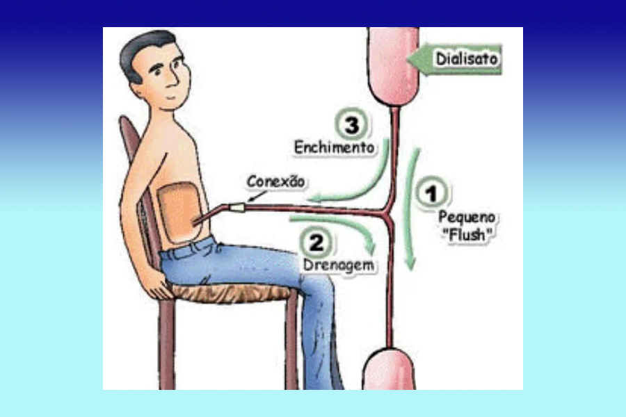 Conheça o que é Diálise Peritoneal e sua importância